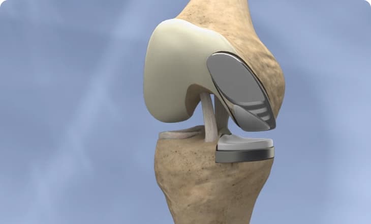 Partial Knee Replacement Video Guide